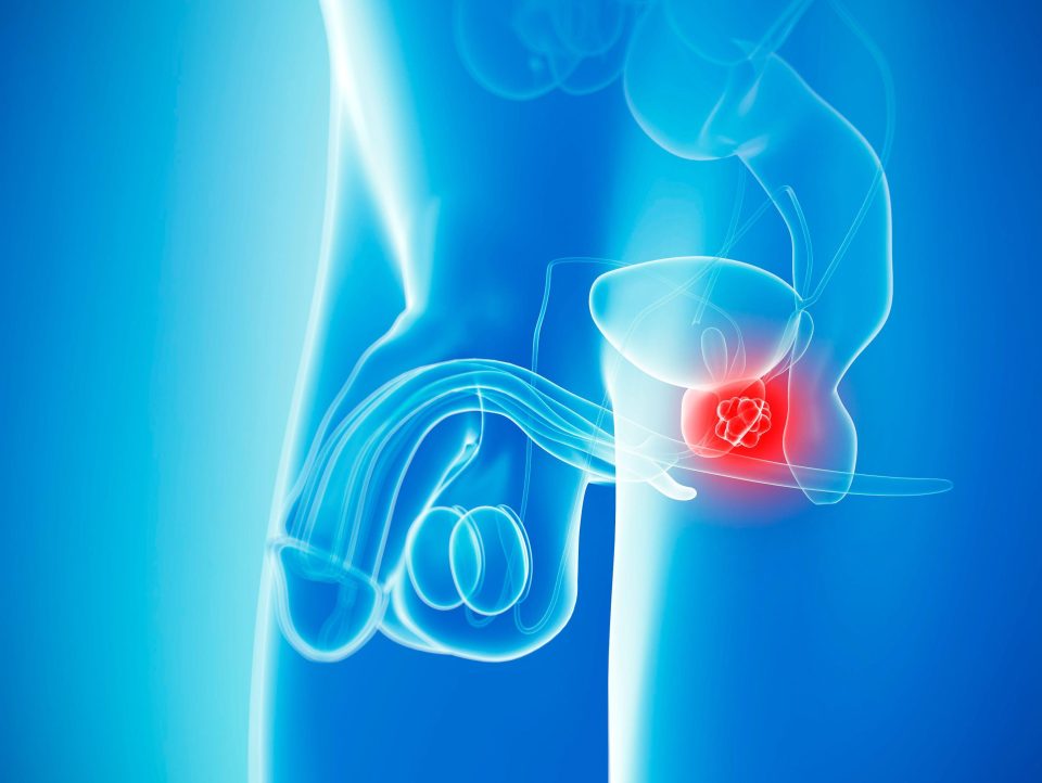  The prostate is located at the base of the bladder