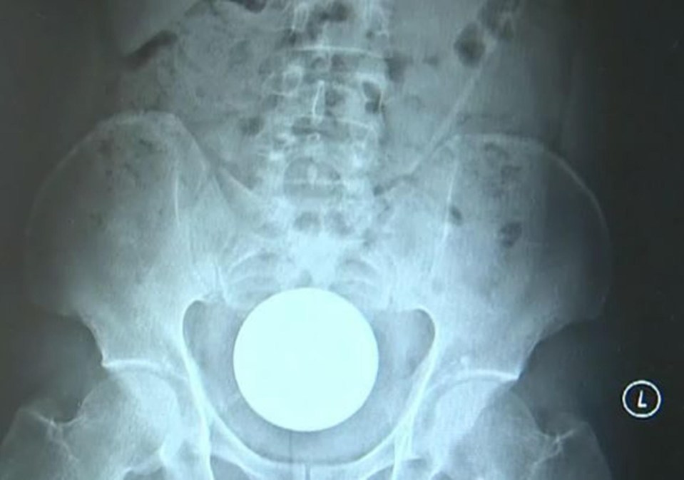 Doctors had to hide their surprise after seeing a glass ball lighting up a scan of the patient