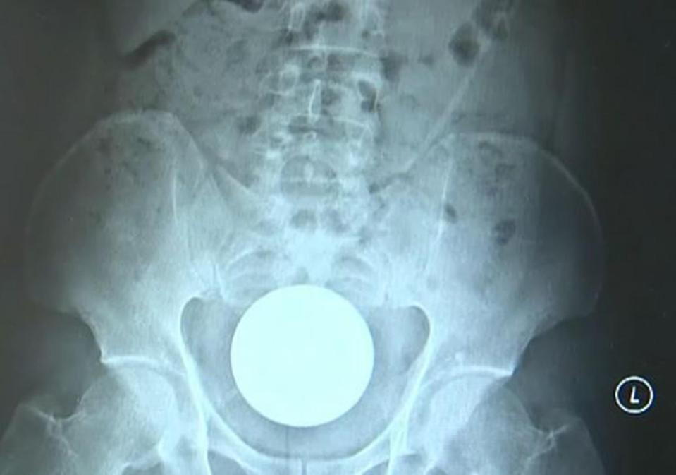  Doctors had to hide their surprise after seeing a glass ball lighting up a scan of the patient