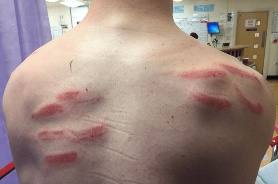 Dan Lincoln reveals the horrific stud marks covering his back