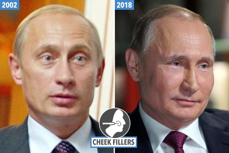 Putin was once a bulgy-eyed Mr Bean lookalike with a chin as weak as your nan’s lemon squash (left). Putin sports a much fuller face these days (right), with Dr Lambe telling Sun Online it’s almost certainly thanks to cheek fillers