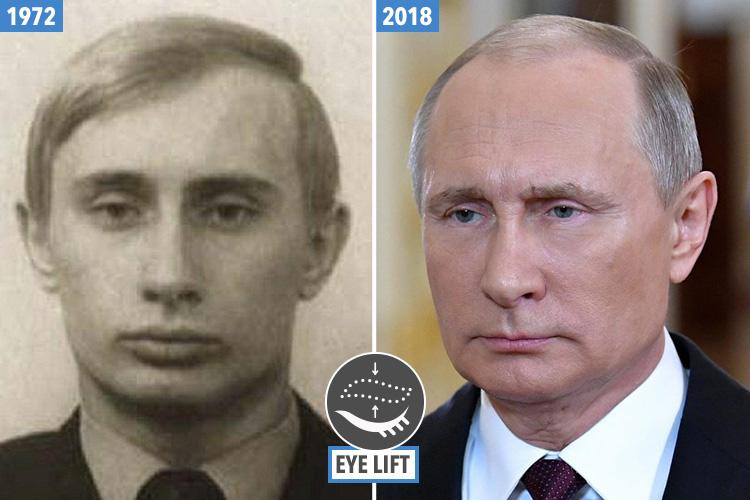 A fresh faced Putin pictured in 1972 (left). His eyelids were a lot heavier in those days. But by last year, his face looked taut and his eye lids much less visible. Dr Lambe says he can see a subtle upper eye lift at work