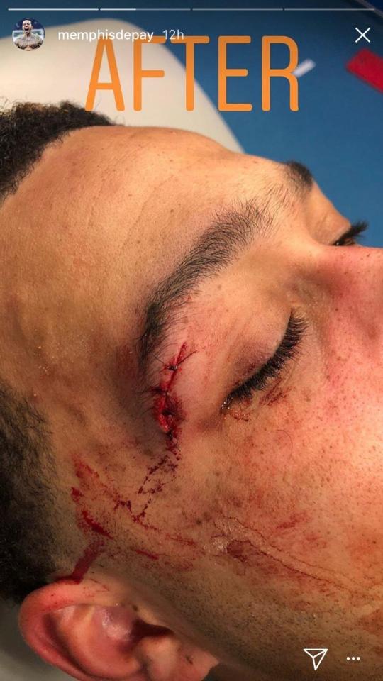  Depay posted the pictures on Instagram of the deep cut that required stitches