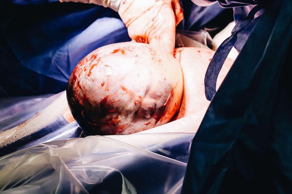  This incredible image shows the "bubble birth" of a baby girl born with her head still encased in her amniotic sac