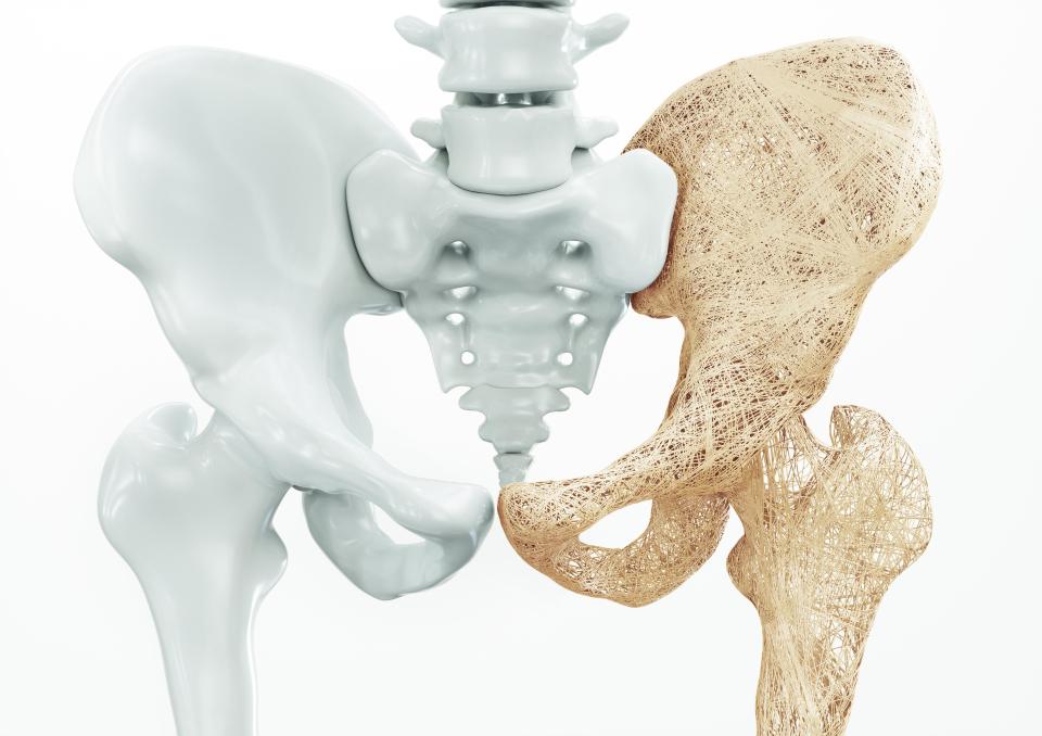  Osteoporosis affects over three million people in the UK alone