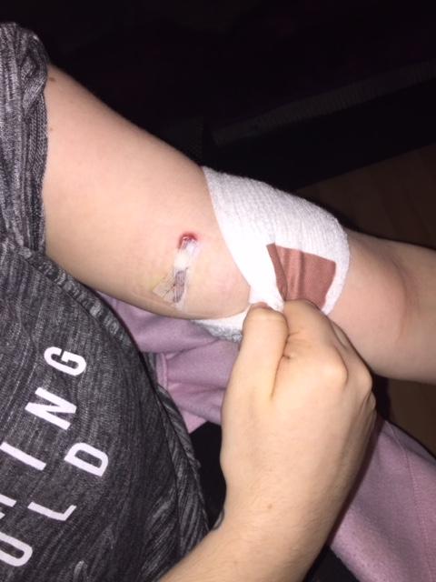  The plastic rod is too deeply embedded in her arm to get to it without her going under the knife