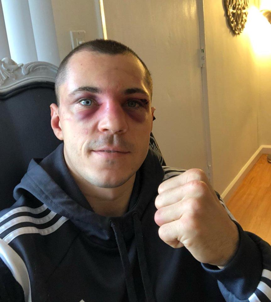  Scott Quigg showed off his broken nose and black eyes after his gruelling fight