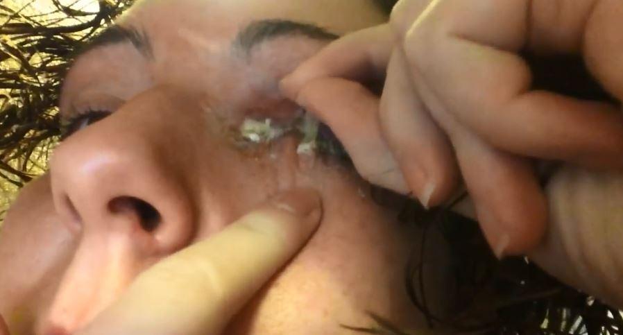  The woman is able to drain the pus from her eye and can wipe it clean afterwards