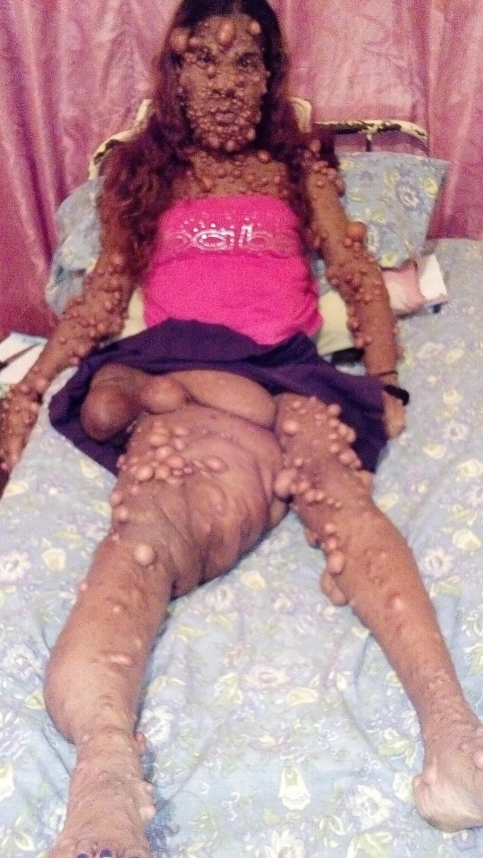 She suffers from neurofibromatosis, a genetic disorder that causes non-cancerous growths