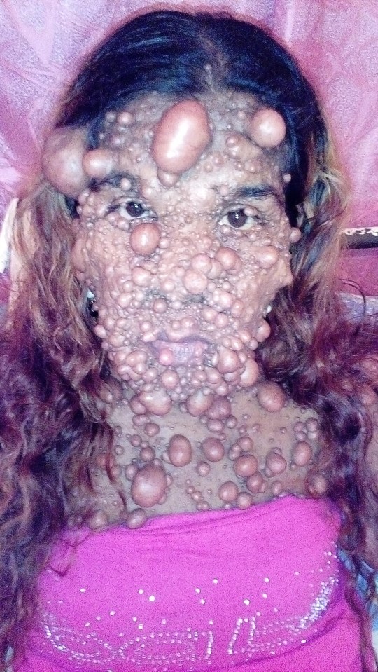 Charmaine has thousands of tumours covering her face and body