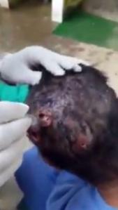  Maggots are seen wedged deep into the patient's head