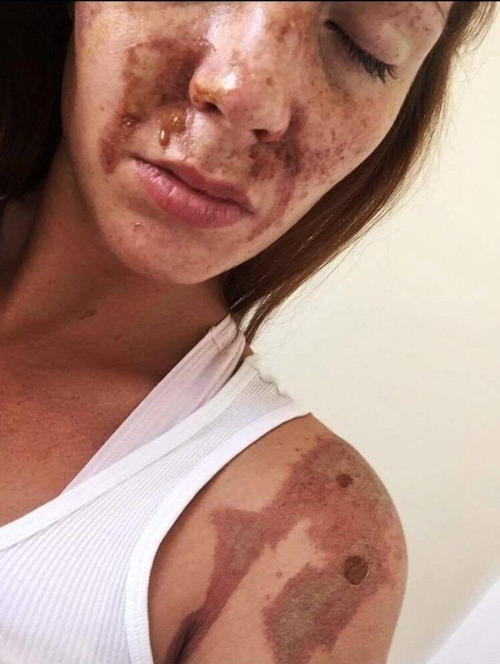  Sophie suffered injuries to her face, back, left shoulder and arm when Collins, 25, threw acid at clubbers a year ago