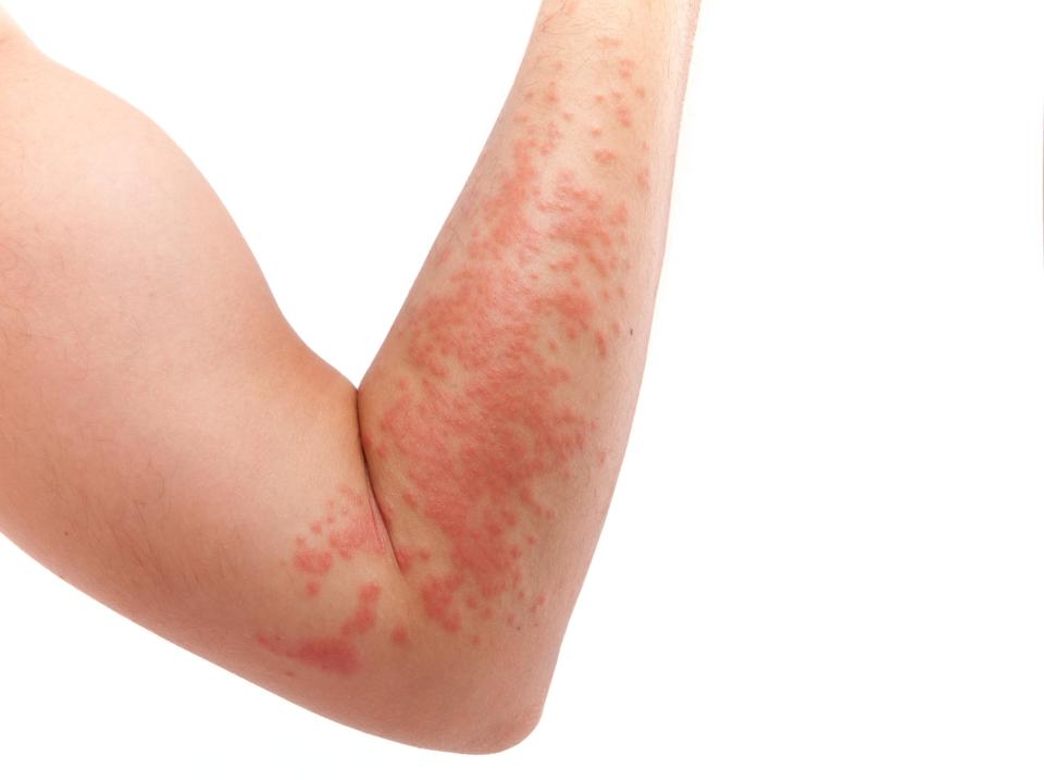  An odd, itchy rash can be a sign of an allergy