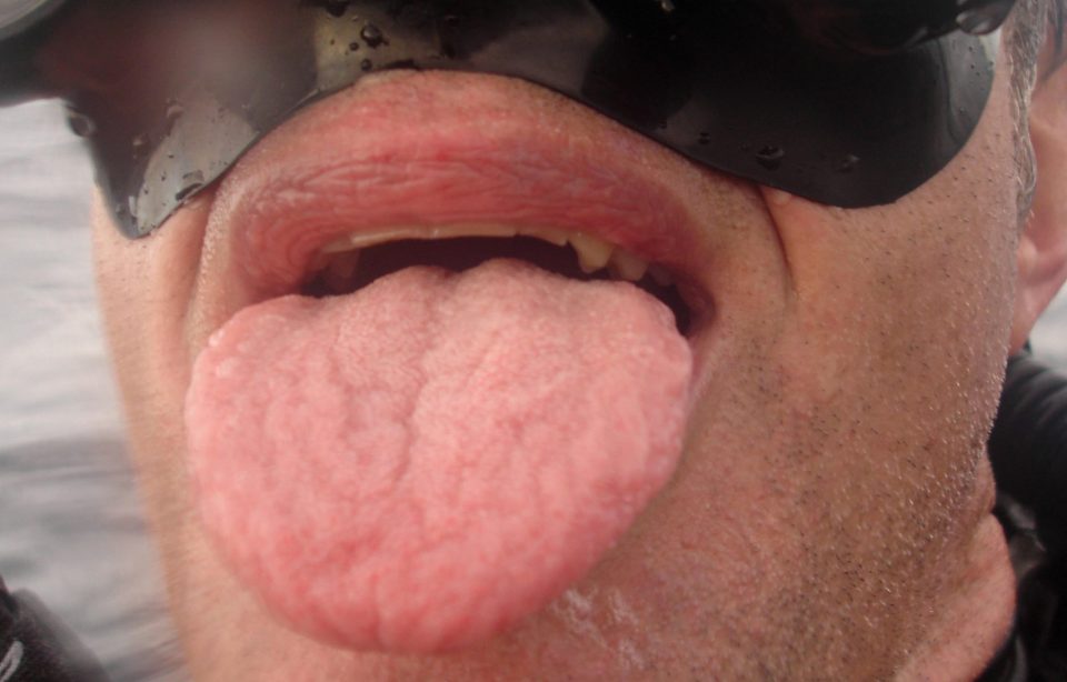  A swollen tongue can be a reaction to protein in fruit and veg