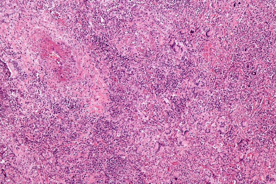 Magnification micrograph of Wegener’s granulomatosis