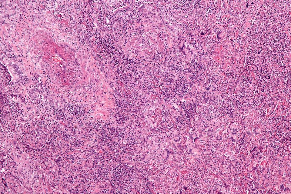  Magnification micrograph of Wegener's granulomatosis