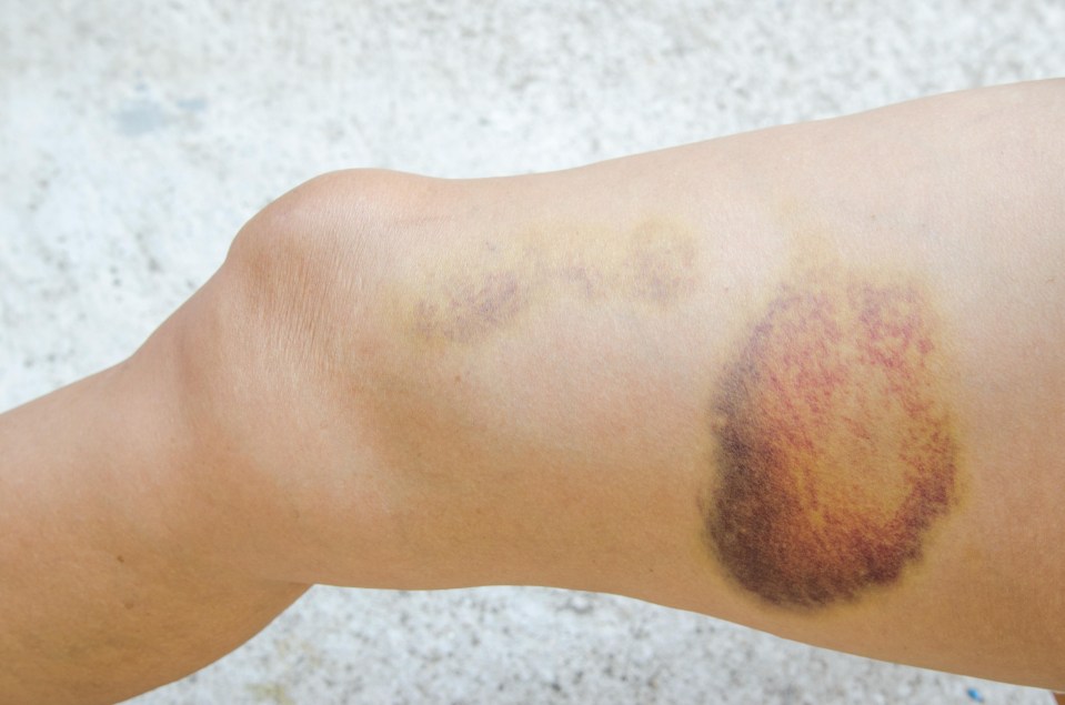 People with EDS may also bruise easier, and take longer to heal