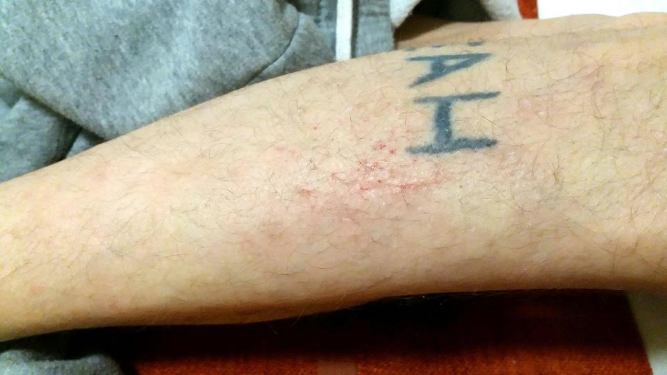  Sam says these marks on his arm were from fleas in the hotel bed