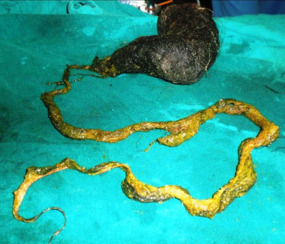  The 'tail' of the hairball measured more than a metre in length