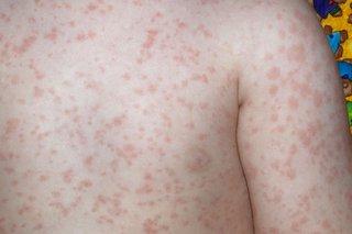  People usually develop a rash on their bodies as well