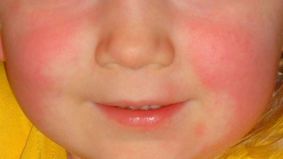  A bright red rash appears on both cheeks