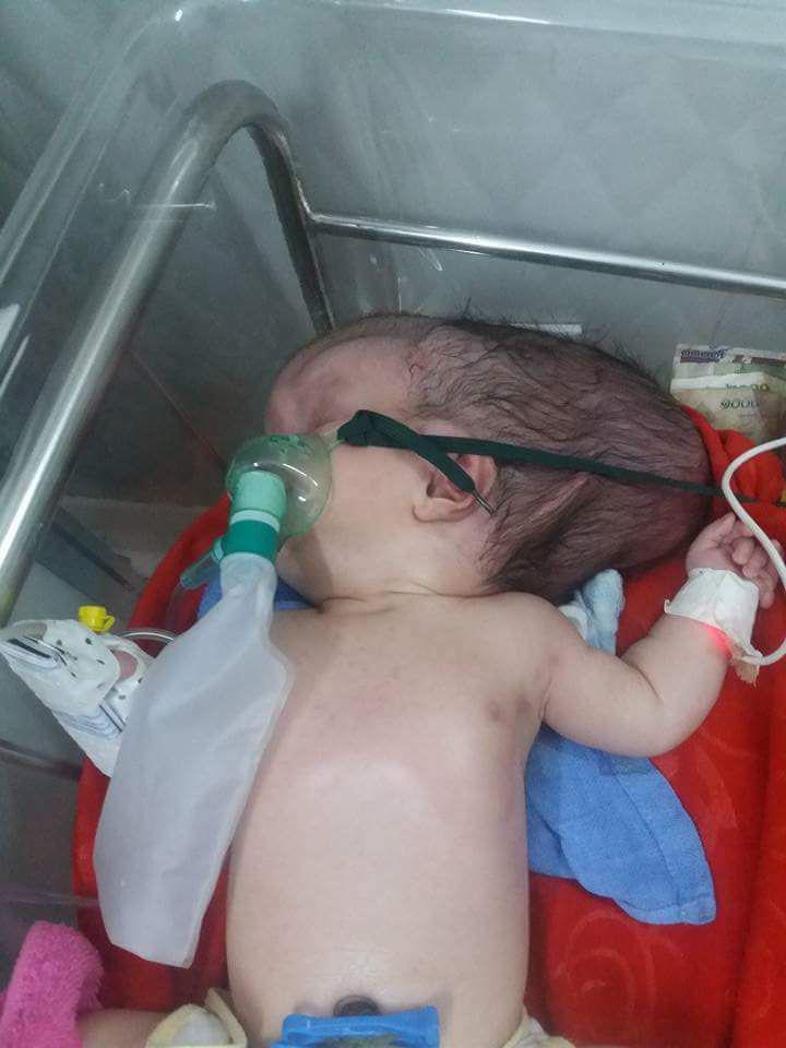  Doctors believe she has anencephaly - a condition that means a portion of her brain and skull are missing