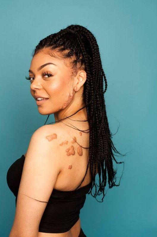  Bianca has about 20 keloid scars - on her back, chest and face