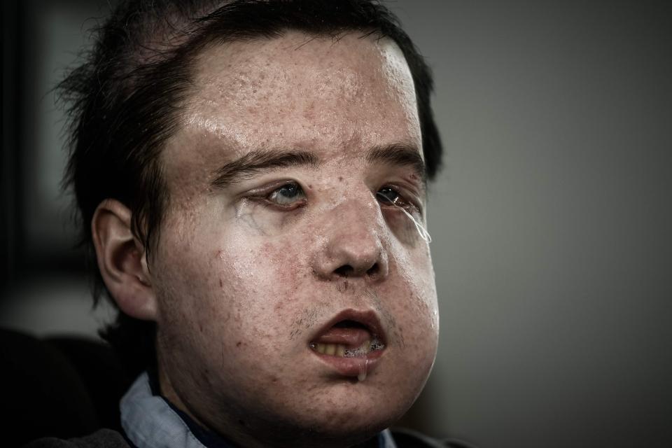  Jerome Hamon, 43, was left severely disfigured due to his tumours, and has undergone face transplant surgery