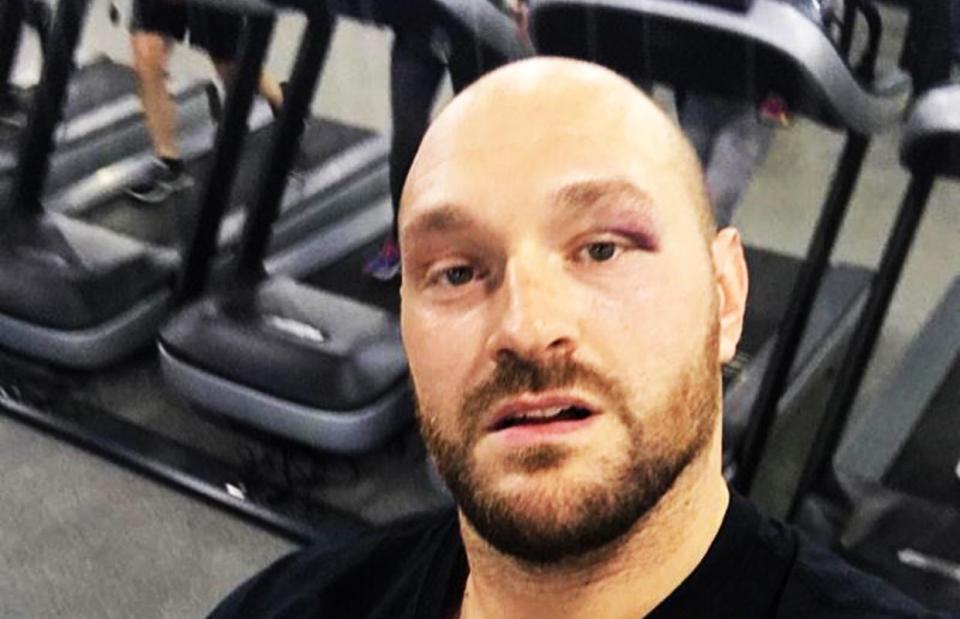  Tyson Fury showed off the black eye he got in sparring David Allen