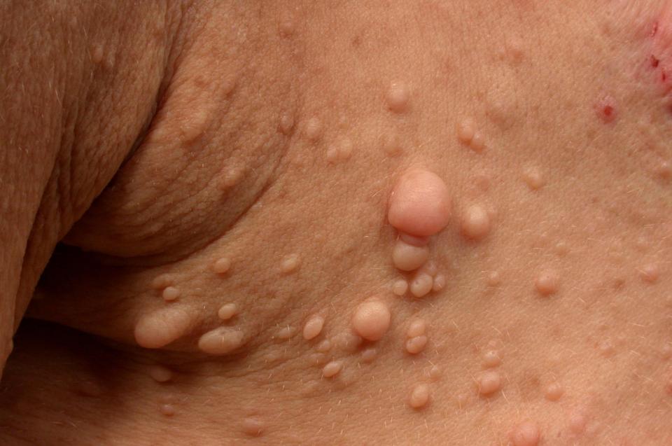  The condition causes bumps on the skin