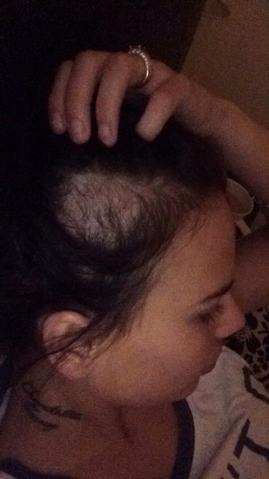  Chantelle Connelly posted a picture of her 'baldy patch' on Facebook