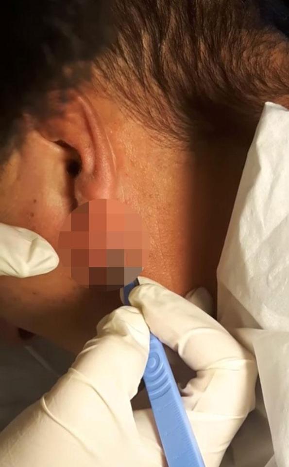  Potentially fatal cyst removals also feature on YouTube