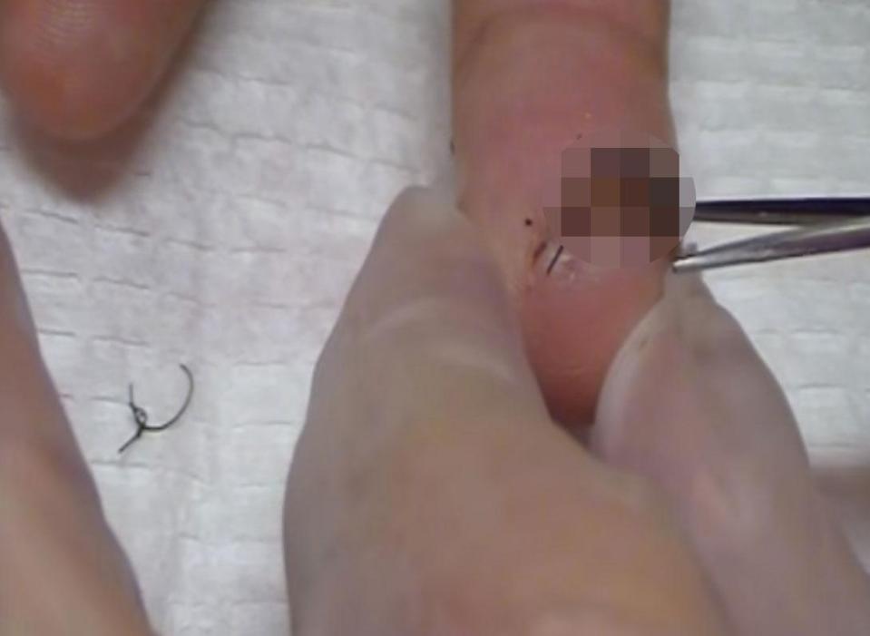  Dangerous clip offers advice for how to remove your own stitches