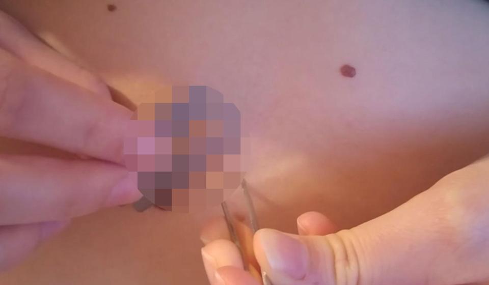  Sick YouTube clips also show how to perform mole removal