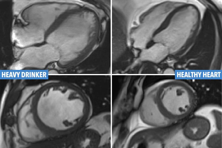 The left picture shows the enlarged heart of someone with alcoholic cardiomyopathy, compared to a healthy heart on the right hand side 