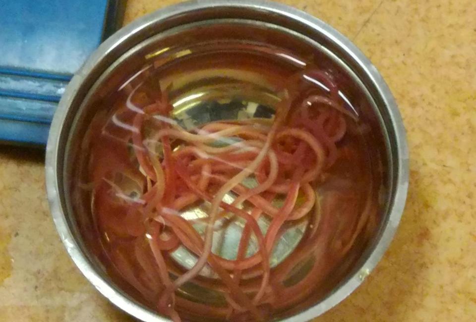  14 roundworms were removed from the woman's bile duct