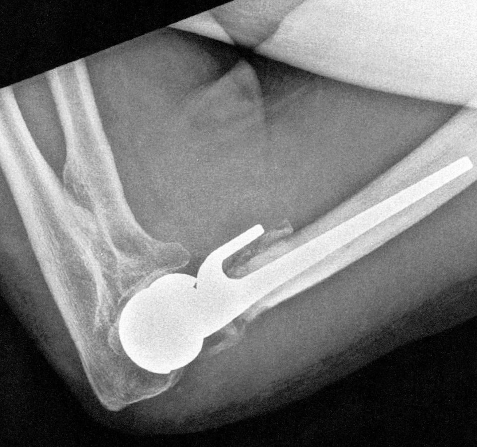  X-ray showing the metal rod that was inserted into Denis's smashed elbow