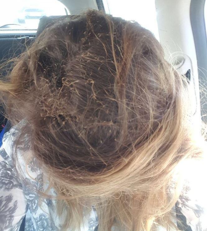  A UK woman was left with a scorched scalp after she said her vape pen blew up