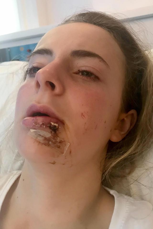  Georgia Hull's horrific injuries after being kicked in the face by an horse