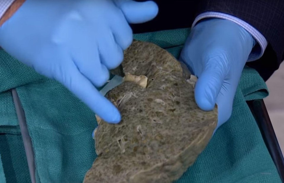 Pointing to nodules in the liver, he explains they are a sign the liver is trying to regenerate itself, but is causing scar tissue