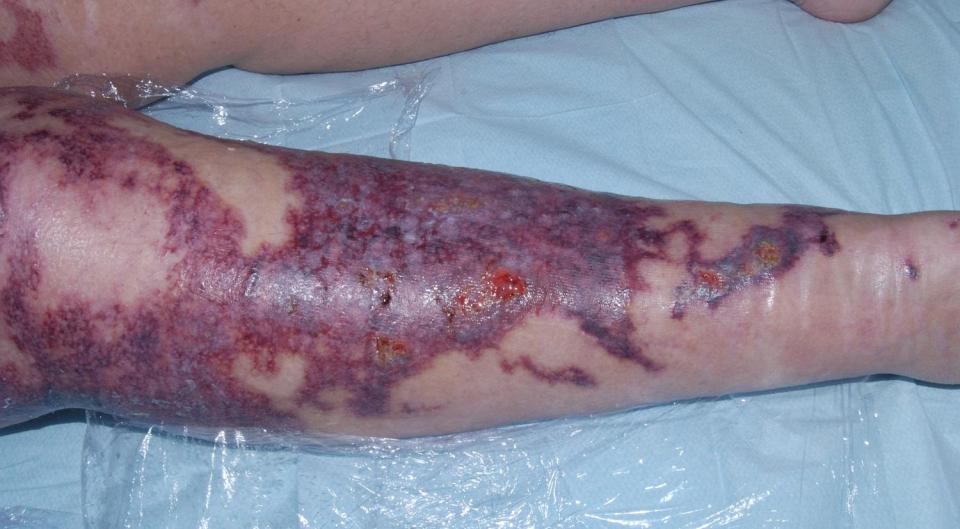  Yvonne Morgan suffered horrific third degree burns in a barbecue fireball