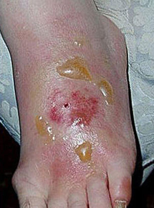  Blandford fly bites can cause swelling and blistering