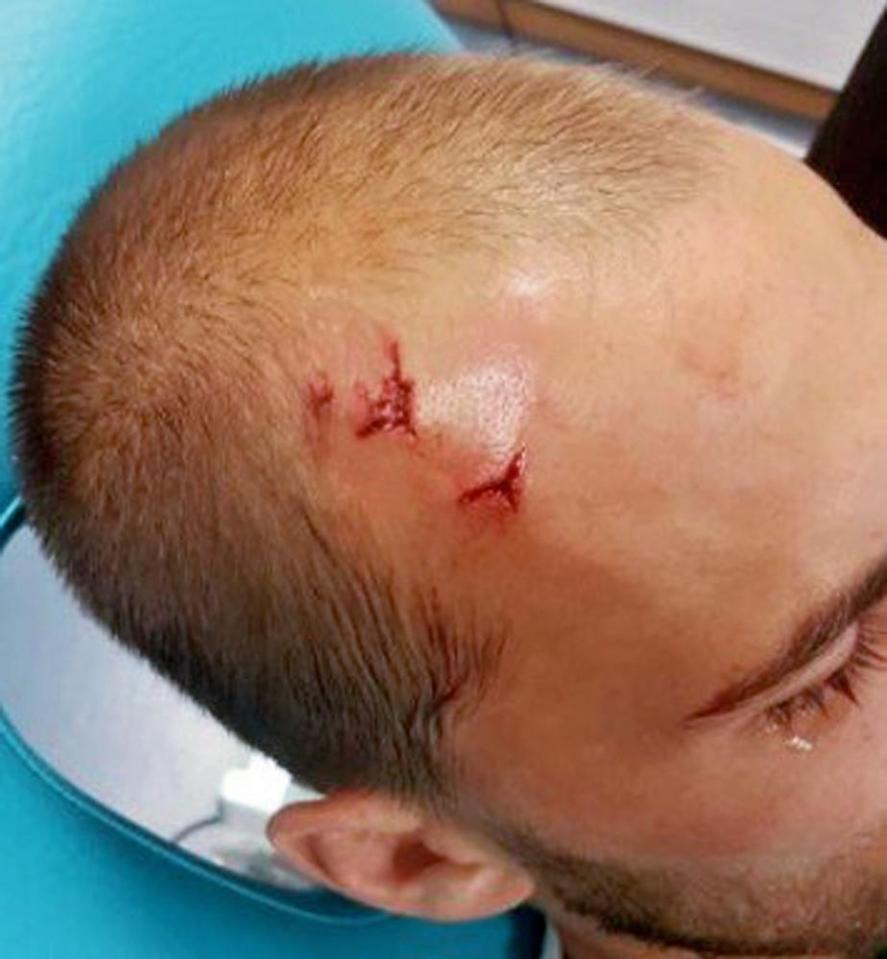  Bas Dost appears to have picked up two nasty cuts in an alleged attack from his own fans