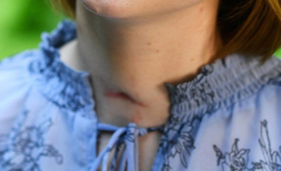 The 33-year-old appeared to have a deep scar on her neck after leaving hospital