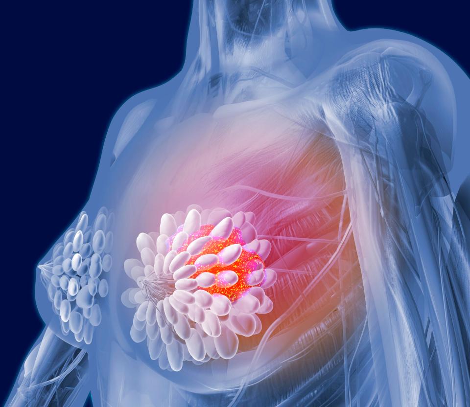  An inverted nipple or discharge is a warning sign for breast cancer