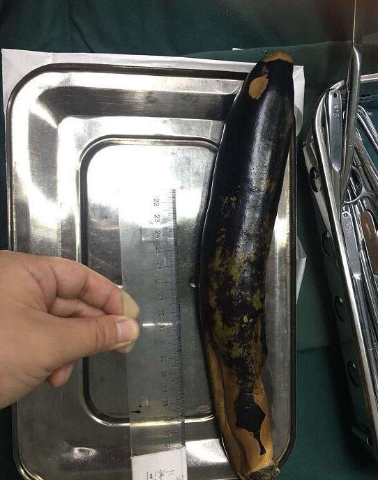 Doctors were able to remove the 1ft long fruit