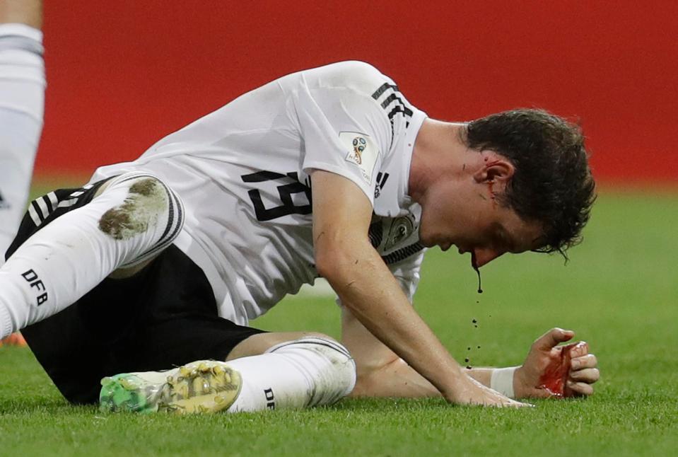  Sebastian Rudy was left with blood dripping from his nose after a clash with Ola Toivonen