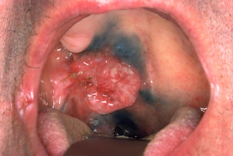  Squamous cell carcinoma is the most common form of mouth cancer