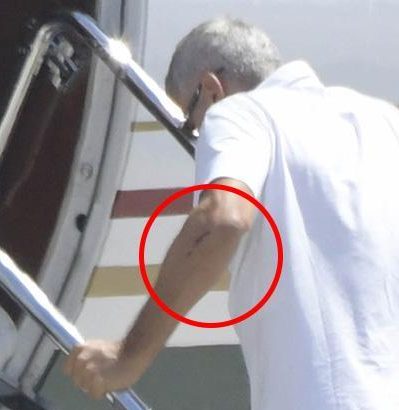  The cuts Clooney suffered in the crash were visible on the back of his arm