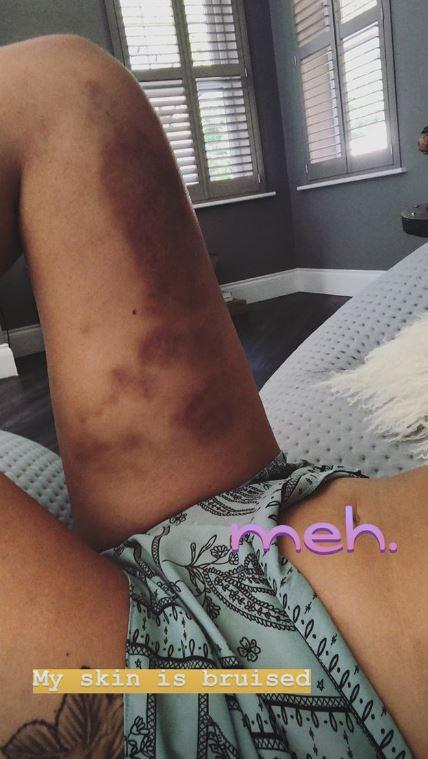  Charlotte recently shared some shocking bruises on her legs to fans